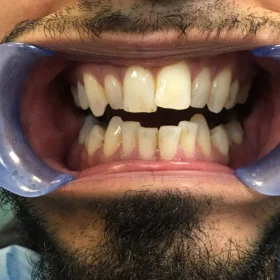 Teeth before