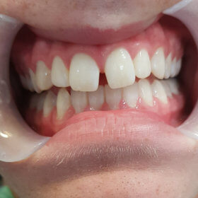 Teeth before