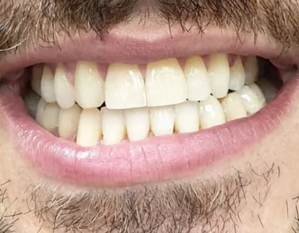 Teeth after