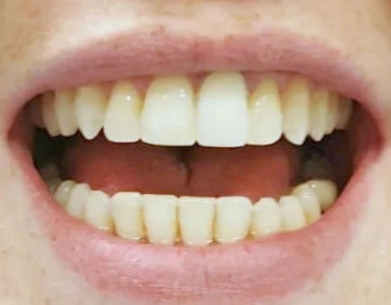 Teeth after